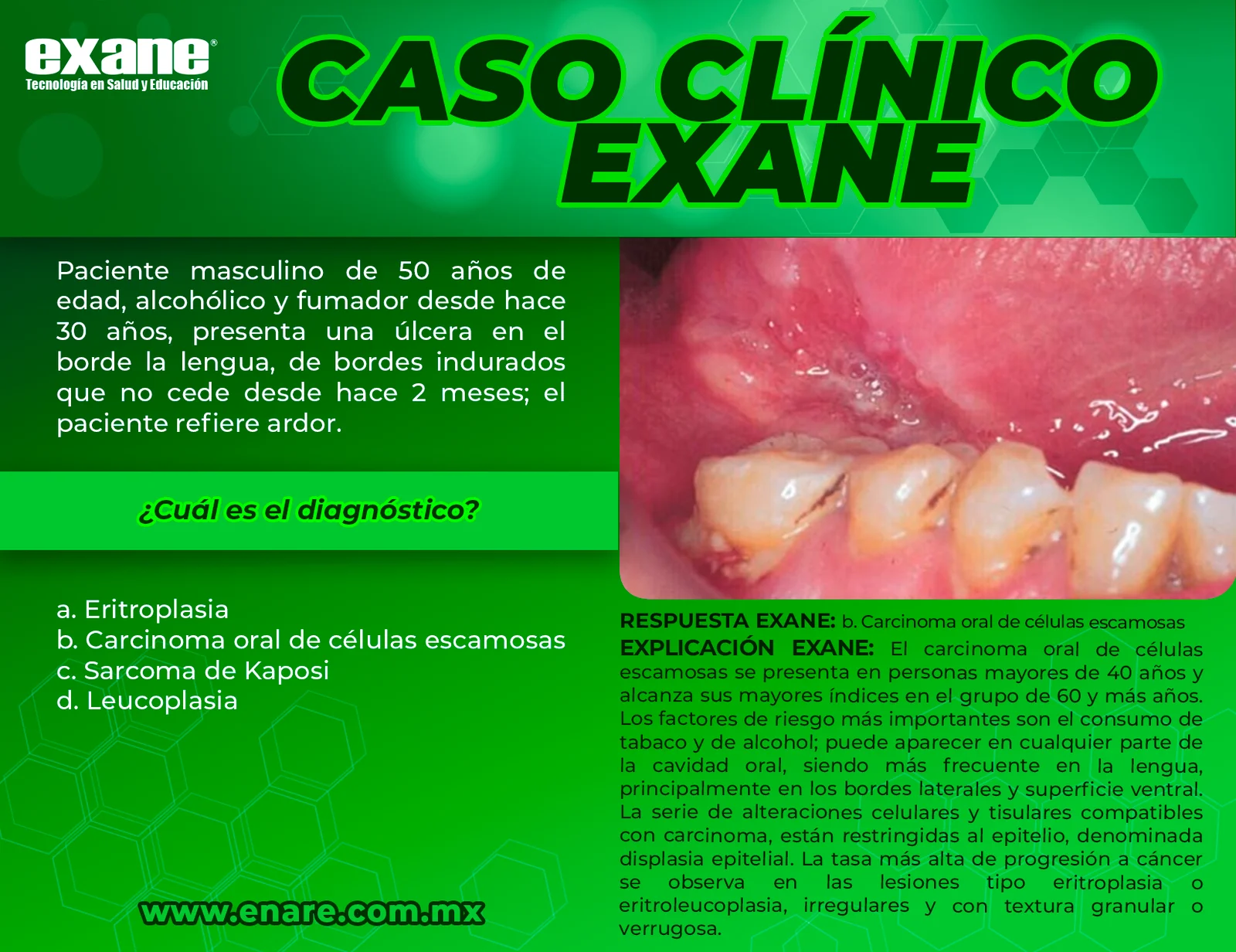 Carcinoma-oral-de-celulas-escamosas-CON-RESPUESTA-subido