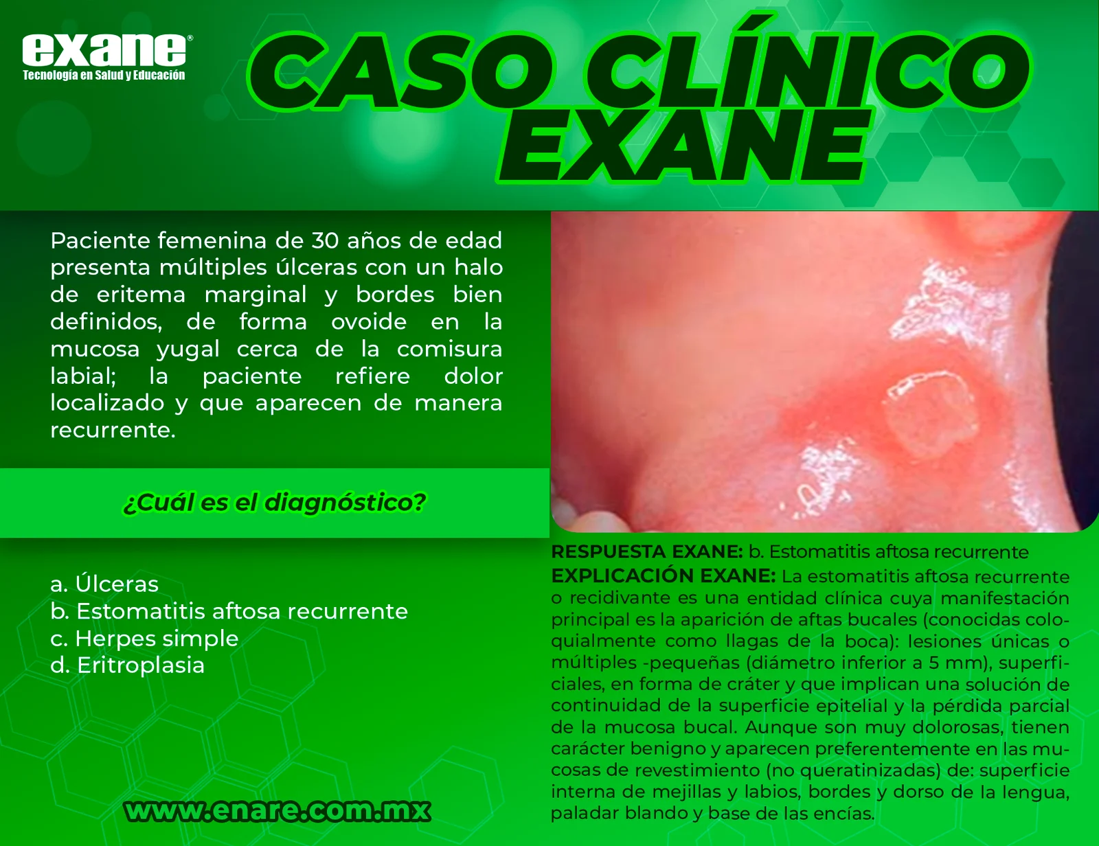 Estomatitis-aftosa-recurrente-CON-RESPUESTA-subido