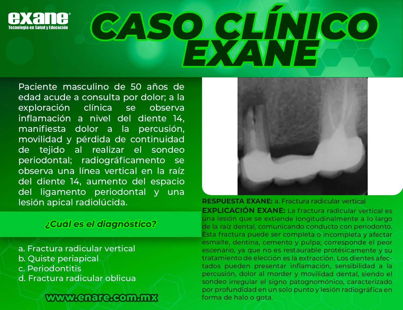 Fractura-radicular-vertical-CON-RESPUESTA