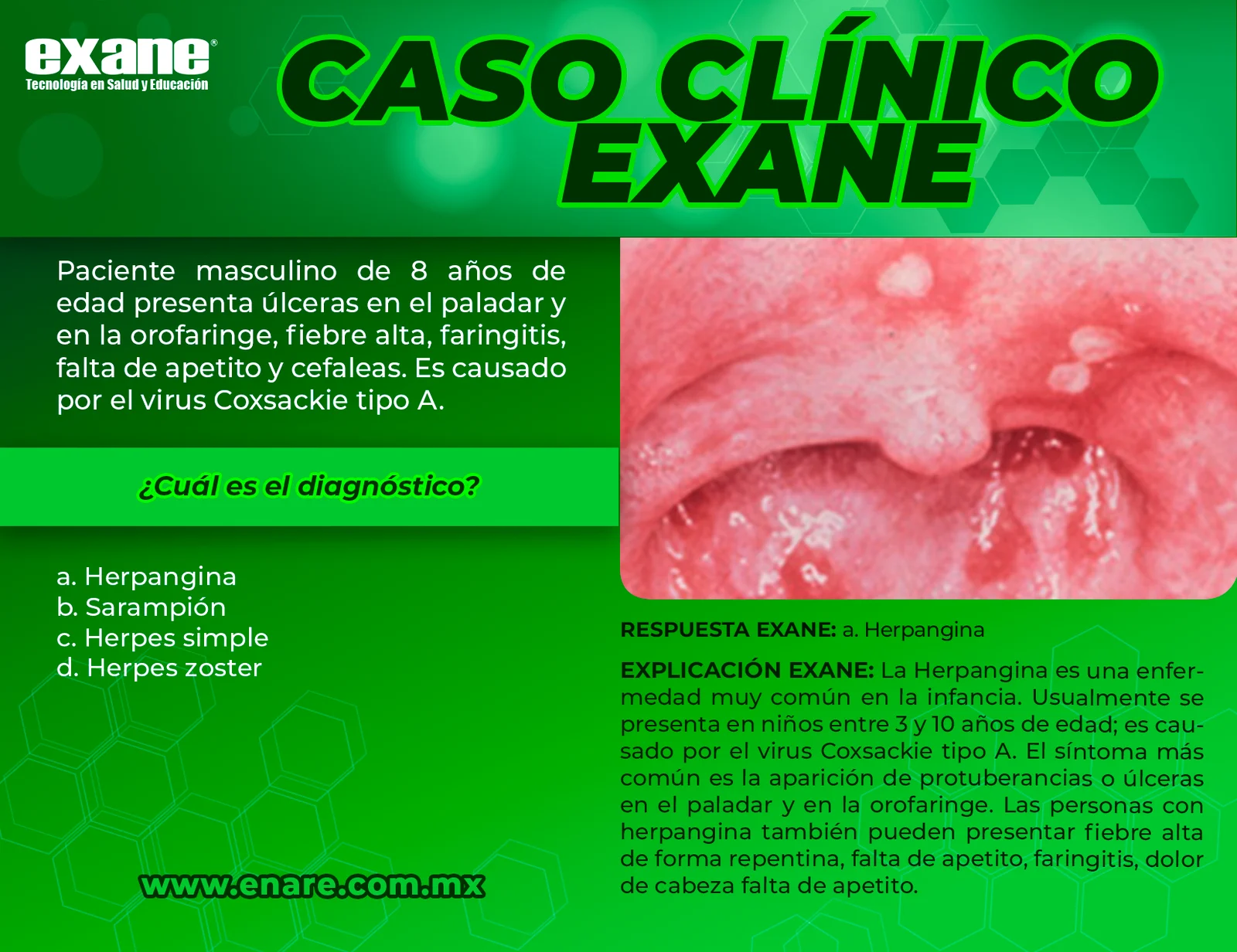 Herpangina-CON-RESPUESTA