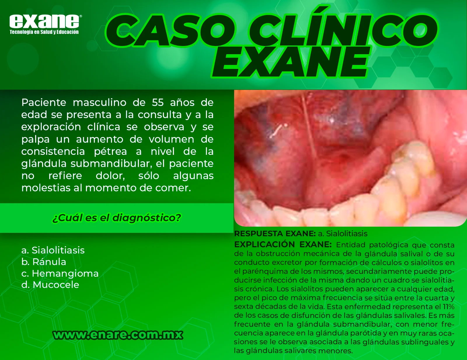 Sialolitiasis-CON-RESPUESTA